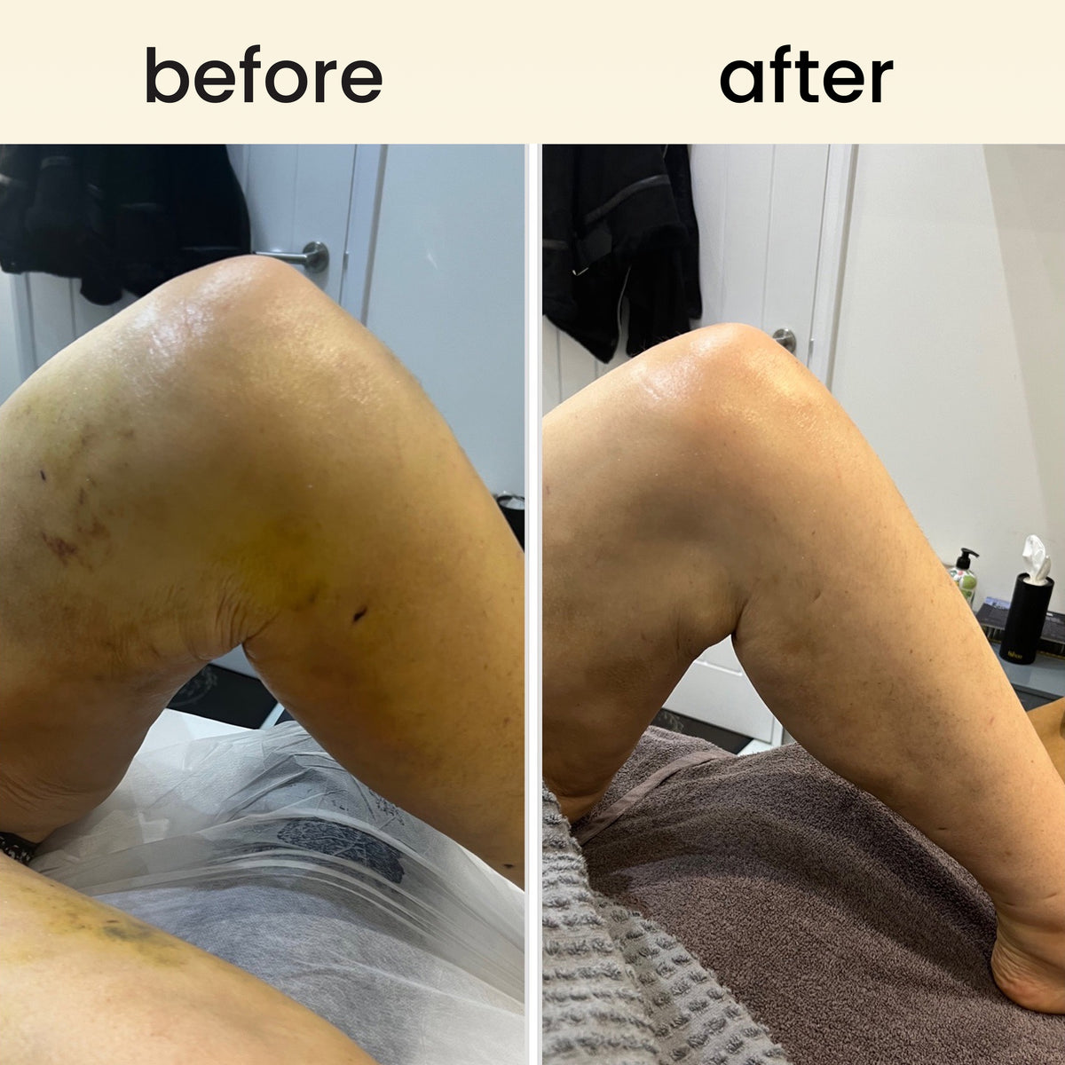 FreeFlow - lymphatic drainage roller