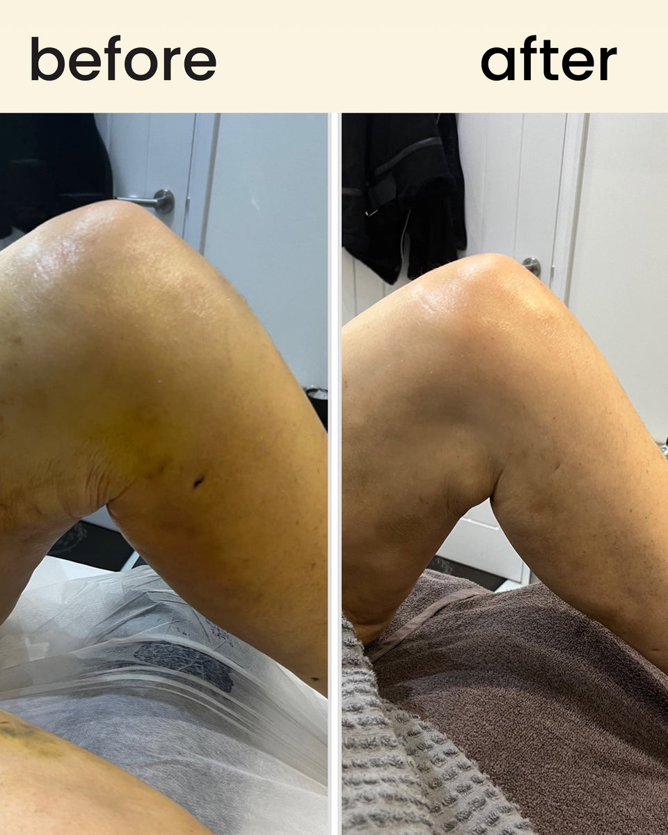 FreeFlow - lymphatic drainage roller