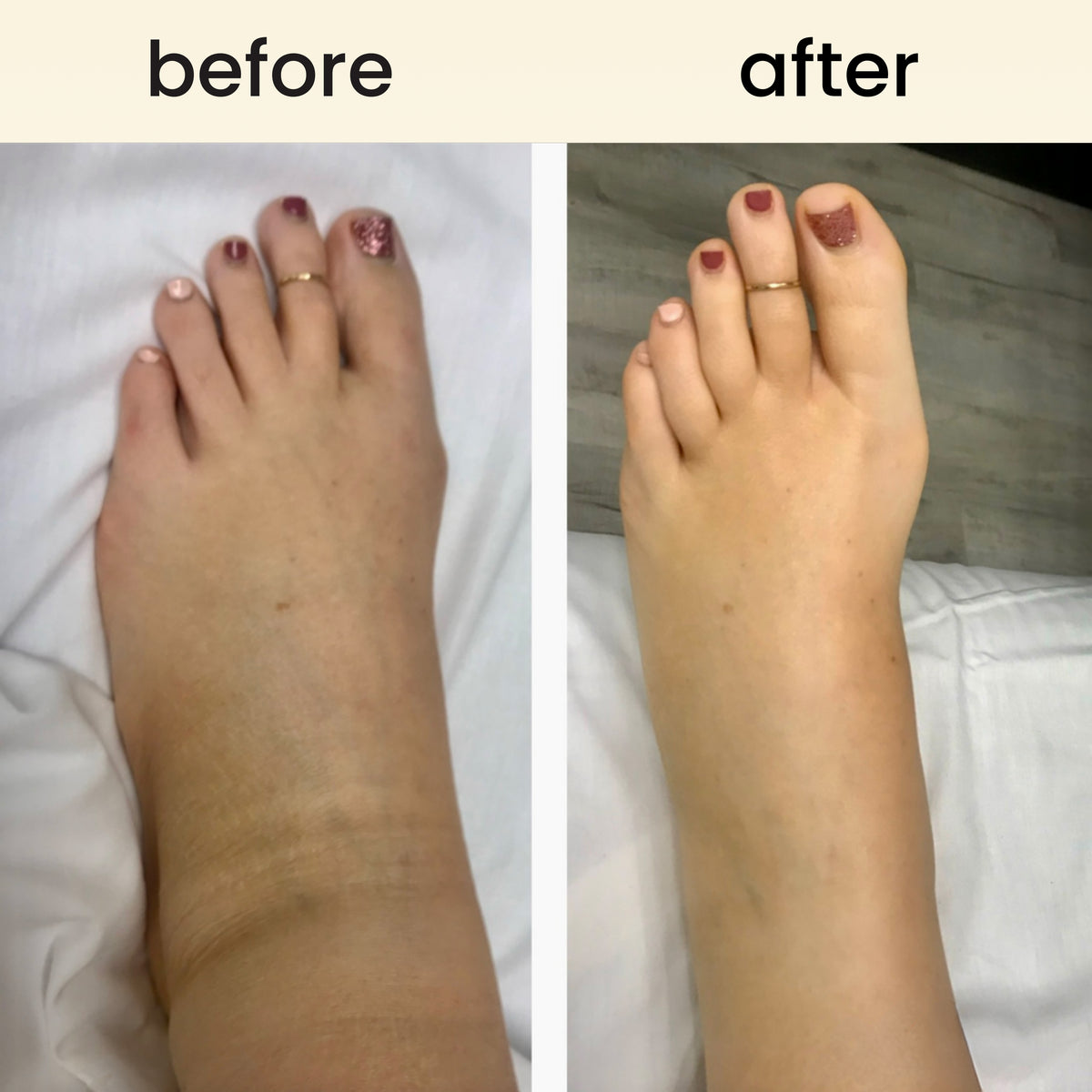 FreeFlow - lymphatic drainage roller