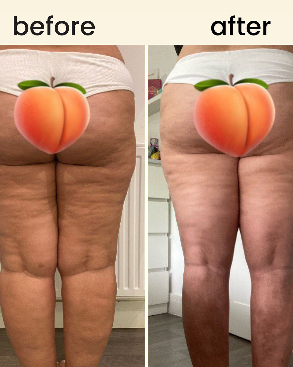 FreeFlow - lipedema massager roller