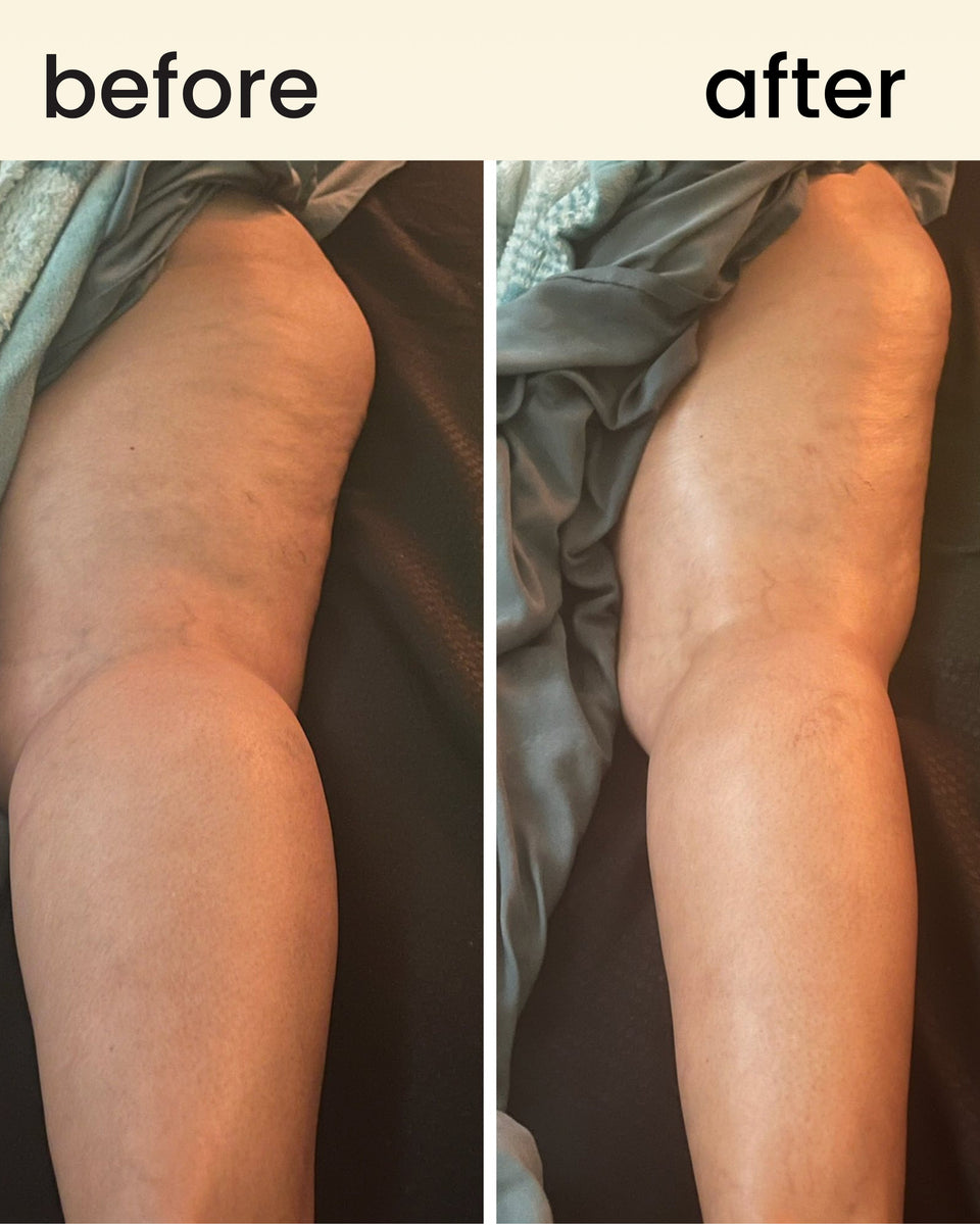 FreeFlow - lipedema massager roller