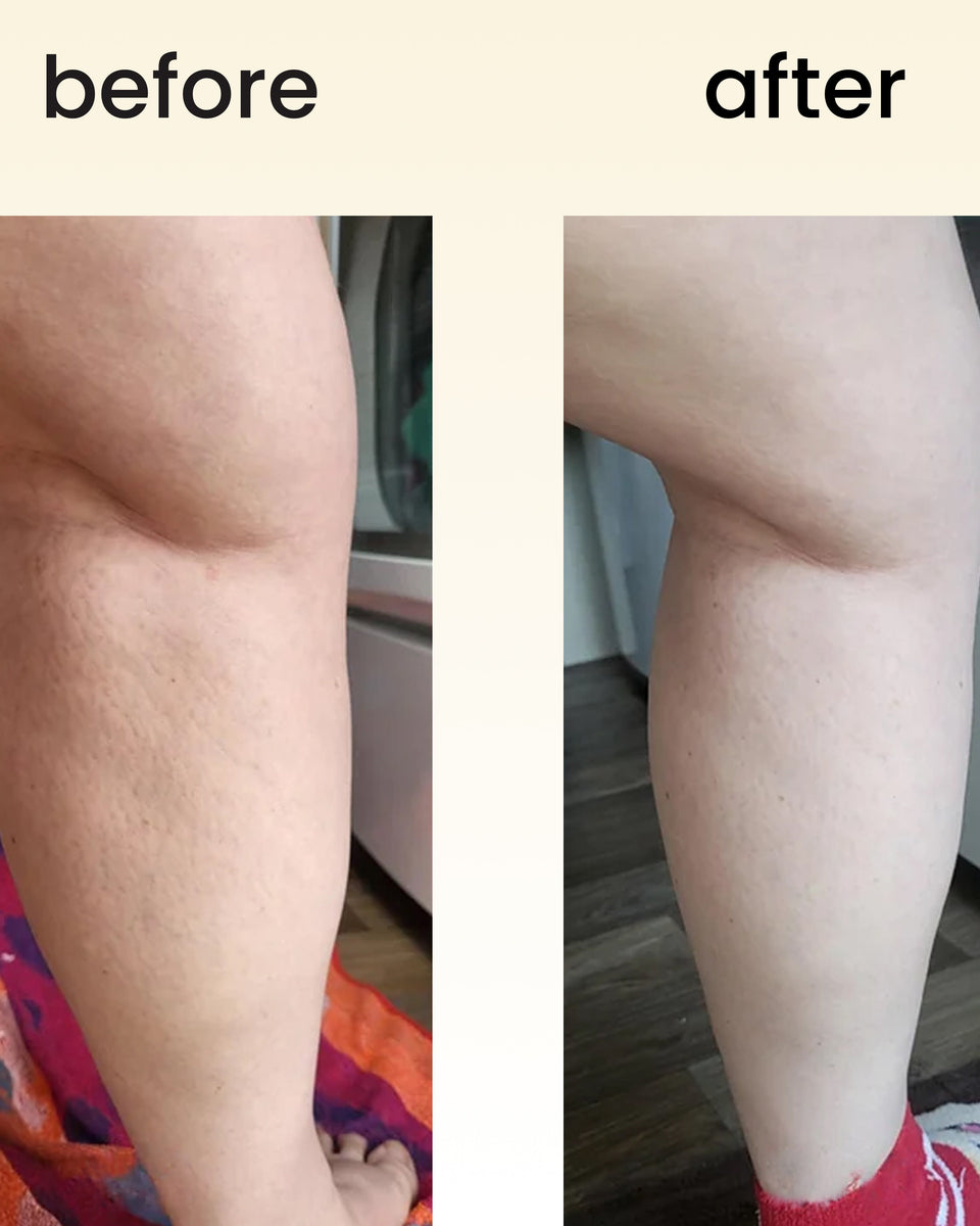 FreeFlow - lipedema massager roller